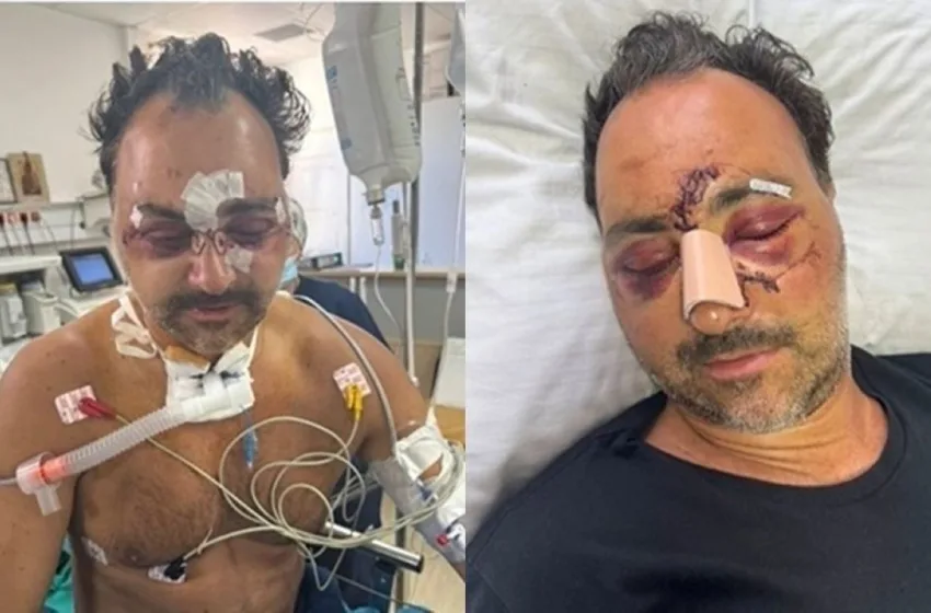  Κρήτη: Ο Ελληνοκαναδός που ξυλοκοπήθηκε κινδυνεύει να χάσει την όραση του- Εσπευσμένα σε χειρουργείο