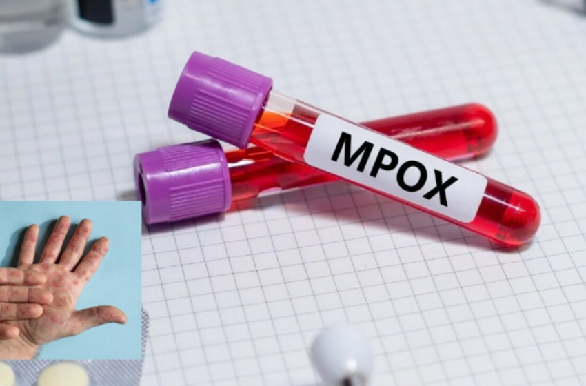  MPOX(ευλογιά πιθήκων): “Δεν είναι μικρή η πιθανότητα να έρθει στην Ελλάδα”-Ποιοι πρέπει να εμβολιαστούν άμεσα